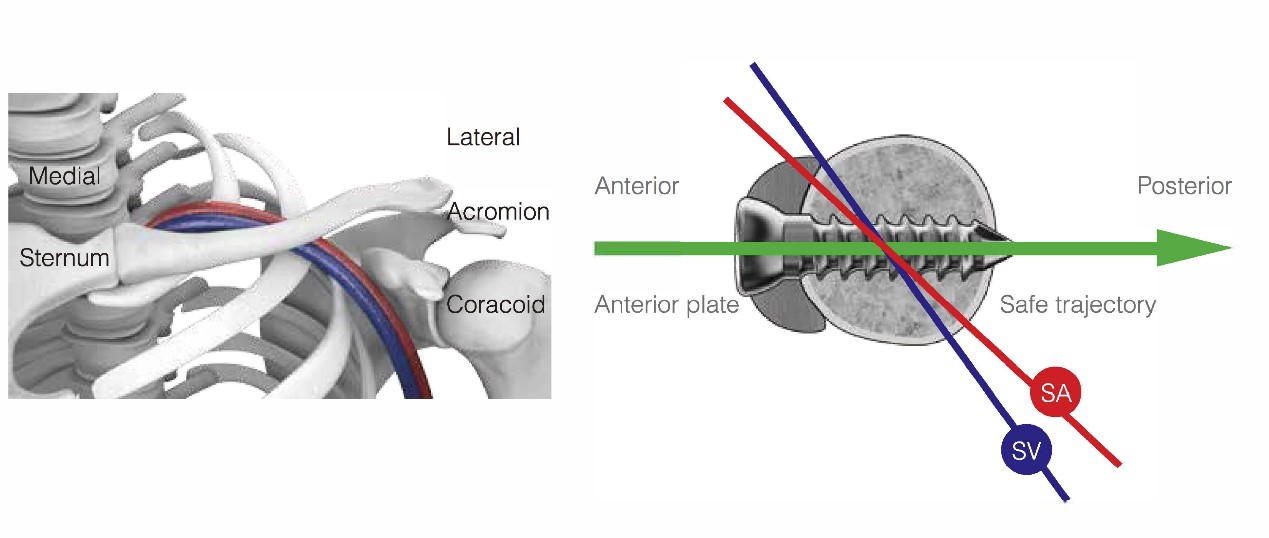 Kompresní dlaha pro zajištění anteromediální klíční kosti 3