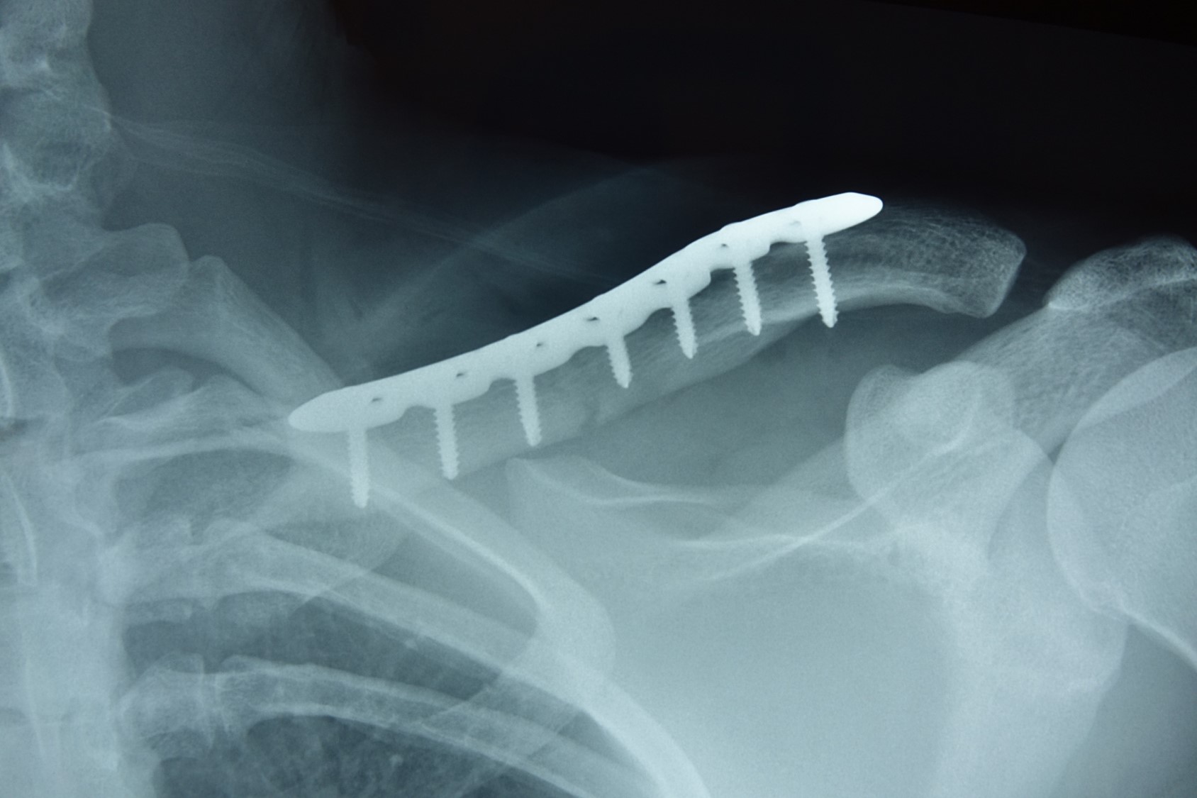 Clavicle Reconstruction Locking Compression Plate 3