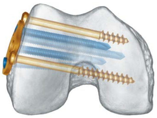 Płytka uciskowa blokująca dystalną boczną kość udową 3