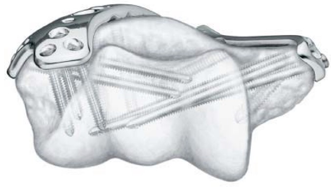 Placca di compressione di bloccaggio dell'omero distale mediale 2