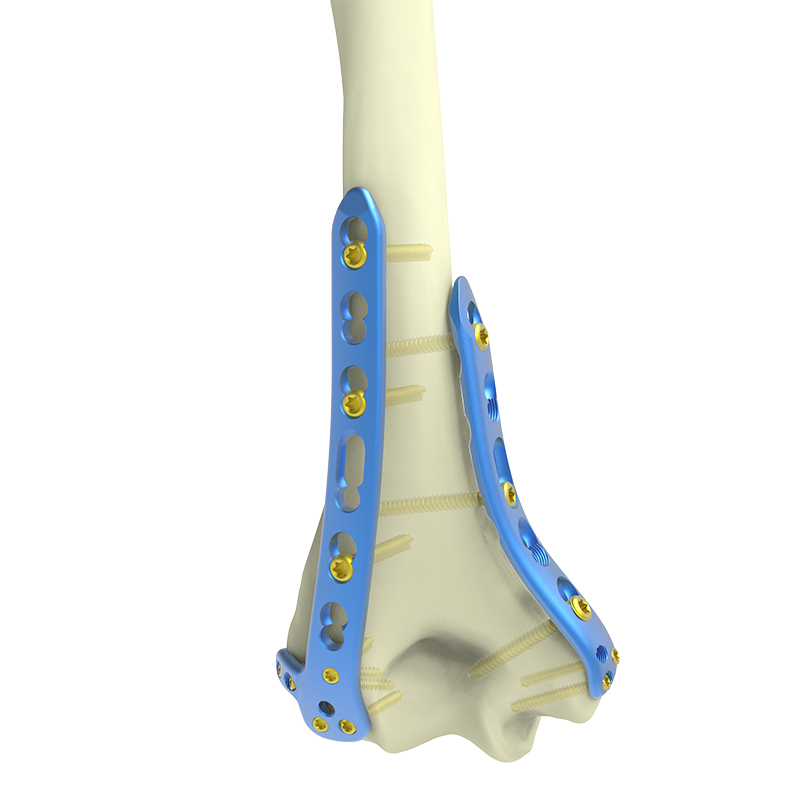 Distālais-aizmugurējais-augšdelma kauls-bloķēšanas-kompresijas-plāksne (ar-sānu-balstu)-3