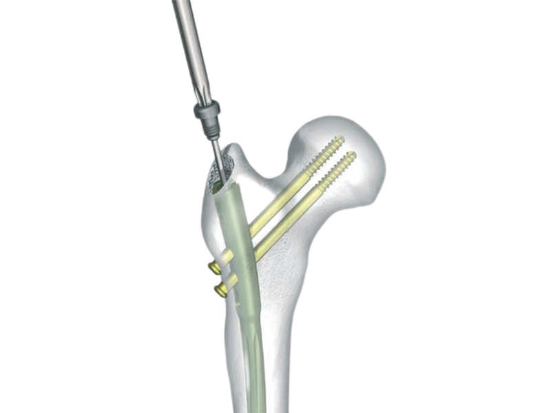 MASFIN-大腿骨-ネイル-5