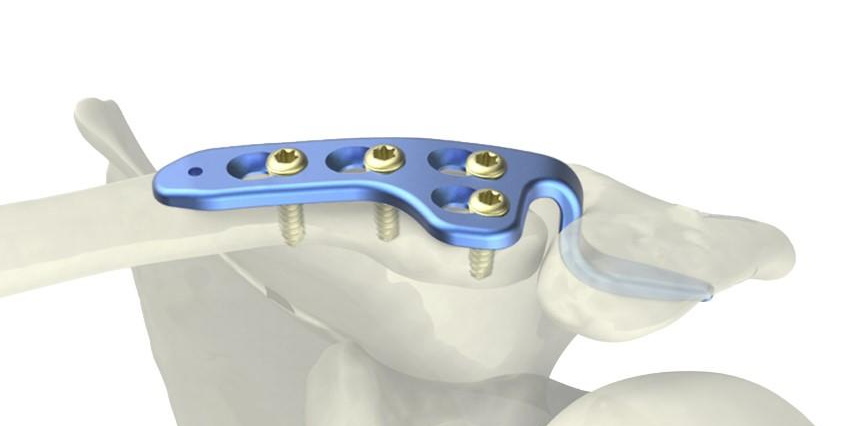 Clavicle Hook Locking Compression Plate 2