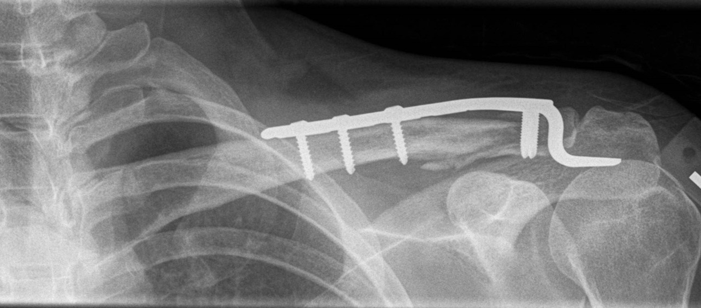 Clavicle-Hook-Locking-Compression-Plate-3