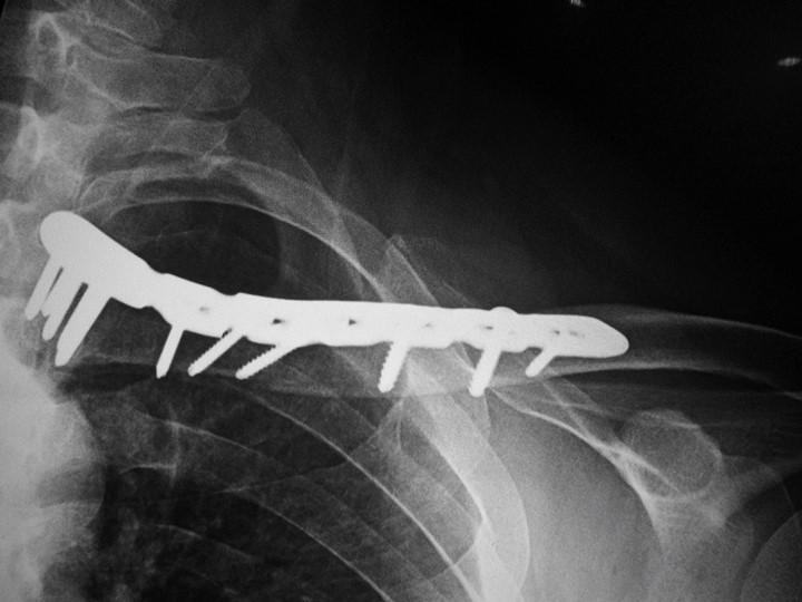 Distal Clavicle Locking Compression Plate 3