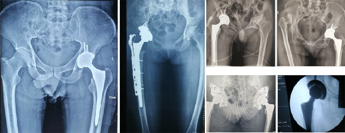 Hip-Joint-Prosthesis-5