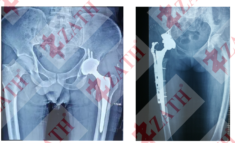 Hip Joint Replacement