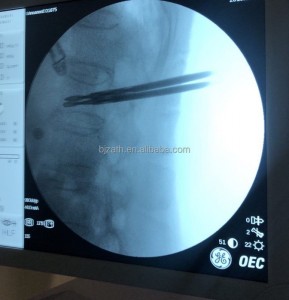 vertebroplasty needle (2)